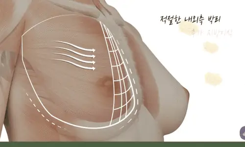 Operasi Payudara untuk Pectus Carinatum: Apakah Ukurannya Hanya Akan Membesar tanpa Belahan Payudara? <Saran Berdasarkan Pengalaman Riset 20 Tahun> — Gambar artikel 4