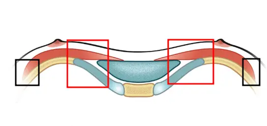 Operasi Payudara untuk Pectus Carinatum: Apakah Ukurannya Hanya Akan Membesar tanpa Belahan Payudara? <Saran Berdasarkan Pengalaman Riset 20 Tahun> — Gambar artikel 6