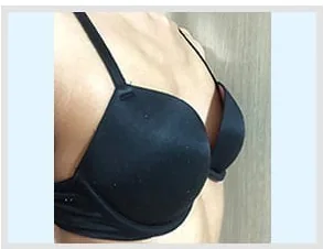 Foto samping sebelum pembesaran payudara 3