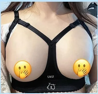 Foto tampak depan hari ke-2 setelah pembesaran payudara dengan bra koreksi 1
