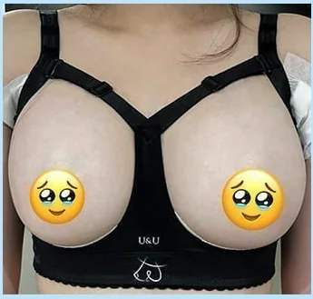 Foto tampak depan hari ke-2 setelah pembesaran payudara dengan bra koreksi 2