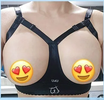 Foto tampak depan hari ke-2 setelah pembesaran payudara dengan bra koreksi 6