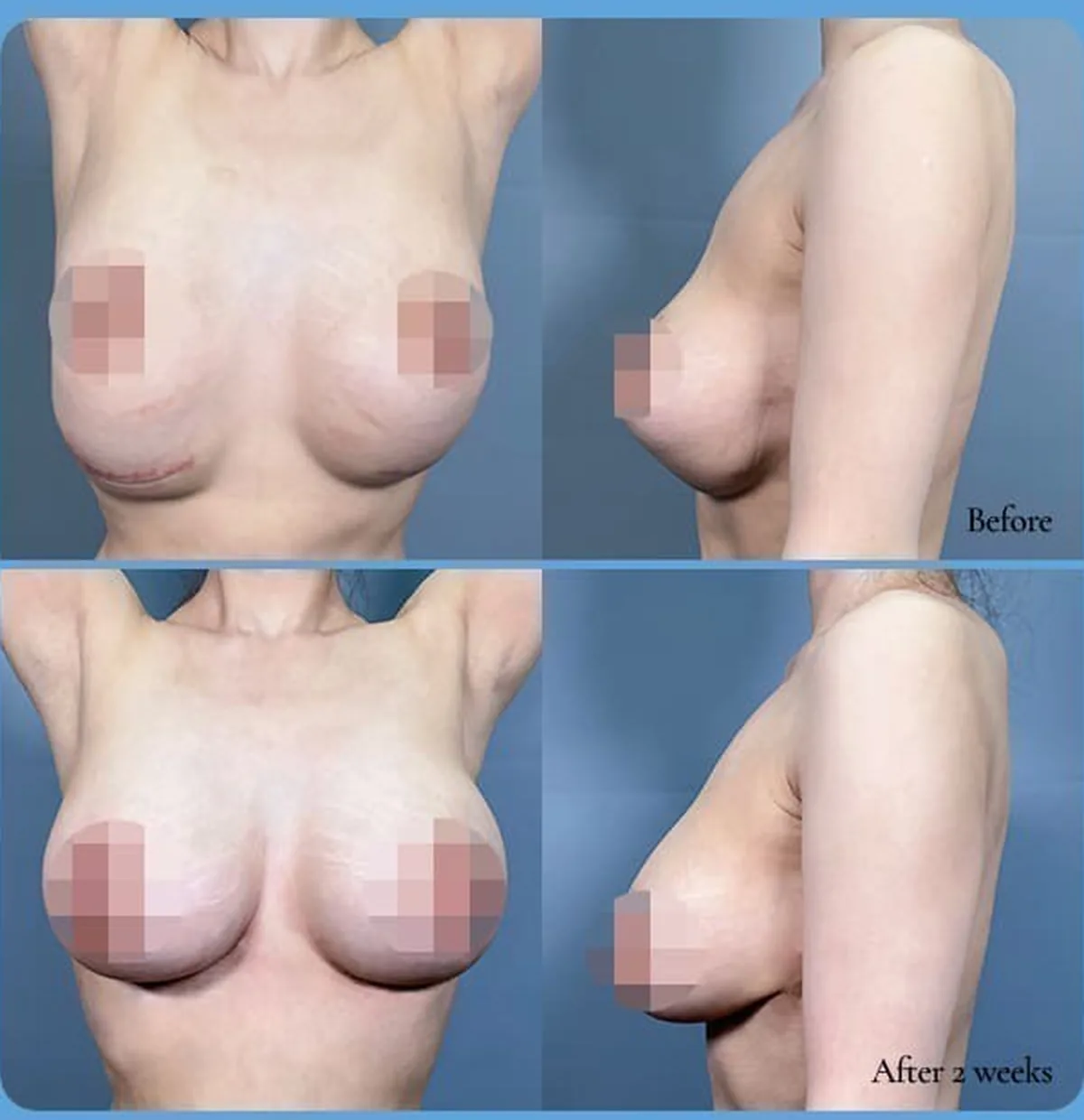 Foto perbandingan sebelum dan sesudah operasi ulang implan turun — Before / After 2 weeks (tampak depan·samping)