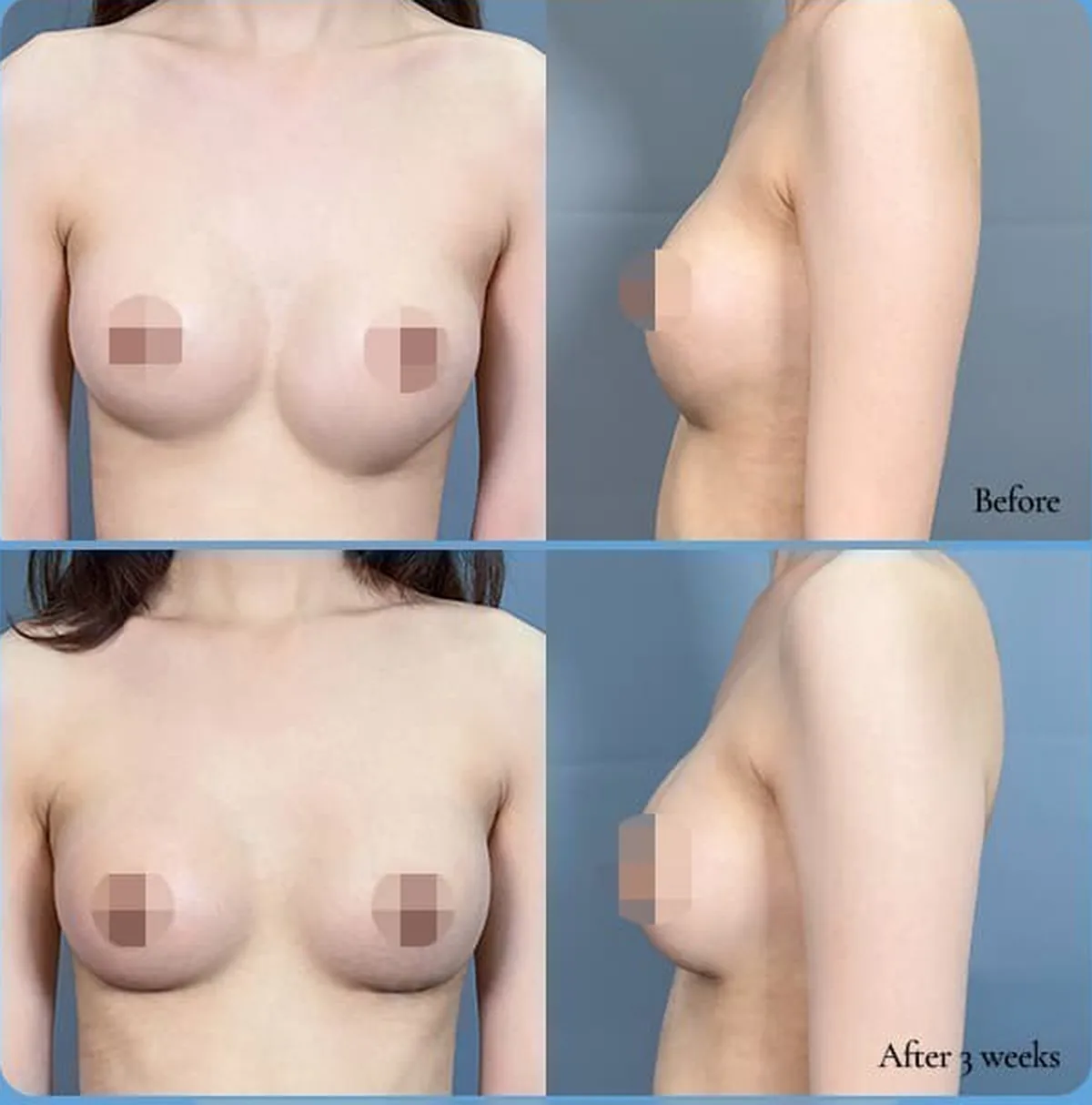 Foto perbandingan sebelum dan sesudah operasi ulang asimetri akibat implan turun — Before / After 3 weeks (tampak depan·samping)