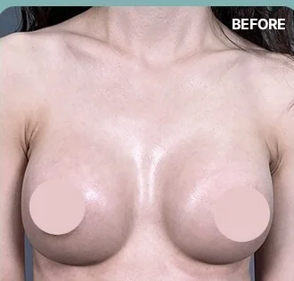 Foto tampak depan sebelum prosedur koreksi belahan payudara