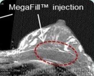 MegaFill™ injection — citra CT lateral payudara dengan area implantasi ditandai