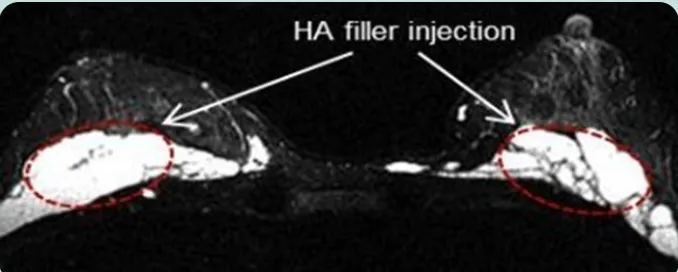 HA filler injection — citra aksial MRI kedua payudara dengan area injeksi filler ditandai