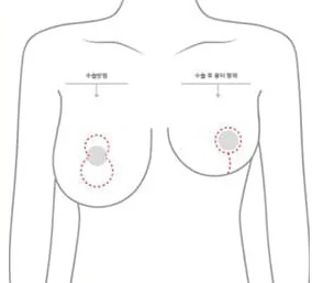 Ilustrasi tubuh bagian atas yang menunjukkan lokasi sayatan vertikal dan bentuk bekas luka setelah operasi
