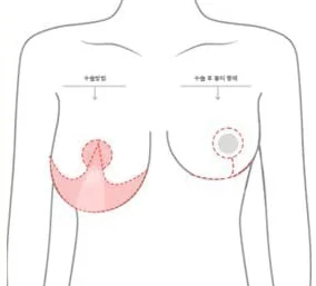 Ilustrasi tubuh bagian atas yang menunjukkan area sayatan inverted-T dan bentuk bekas luka setelah operasi