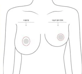 Ilustrasi tubuh bagian atas yang menunjukkan lokasi sayatan areola dan bentuk bekas luka setelah operasi