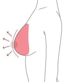 Ilustrasi samping pembesaran payudara yang menambah volume hanya dengan memasukkan implan