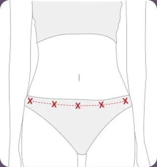 Ilustrasi garis jahitan di dalam garis bikini setinggi tulang panggul