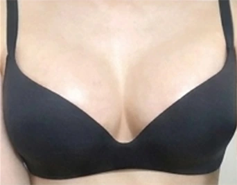 Foto mengenakan bra setelah pembesaran payudara 1