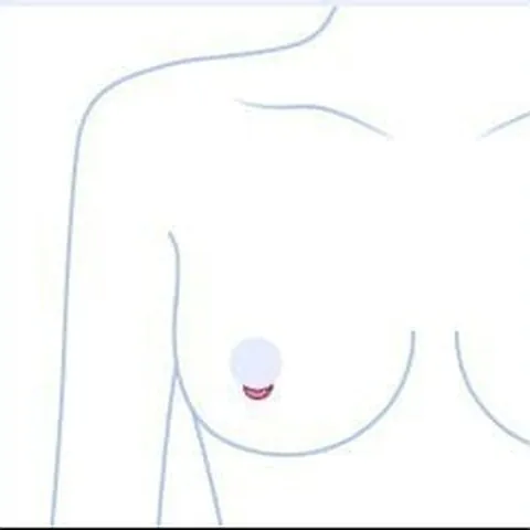 Ilustrasi tubuh bagian atas yang menunjukkan lokasi sayatan areola