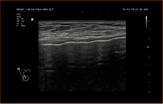 Healthy Breast USG Implan Payudara img11 m