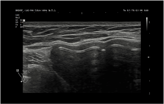 Healthy Breast USG Implan Payudara img6 m