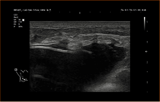 Healthy Breast USG Implan Payudara img8 m