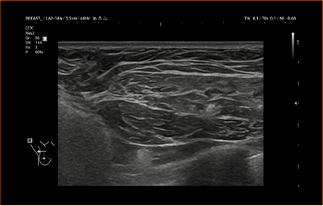 Healthy Breast USG Implan Payudara img9 m