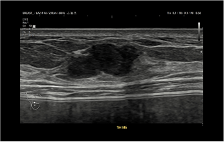Healthy Breast USG Kanker Payudara img10 m