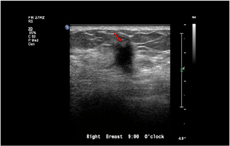 Healthy Breast USG kanker payudara img11 m