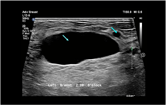Healthy Breast USG kanker payudara img12 m