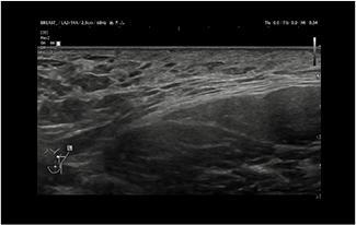 Healthy Breast USG kanker payudara img13 m