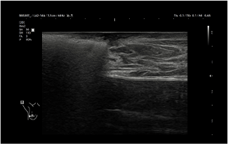 Healthy Breast USG kanker payudara img14 m