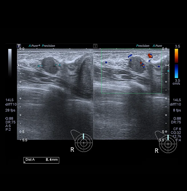 Healthy Breast USG kanker payudara img17 m