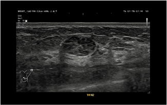 Healthy Breast USG kanker payudara img9 m