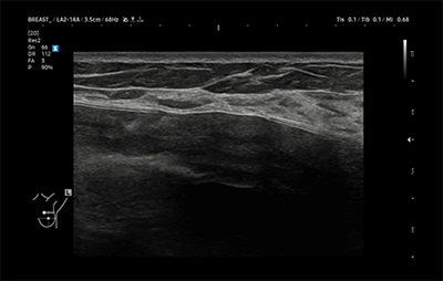 healthy breast USG implan img10