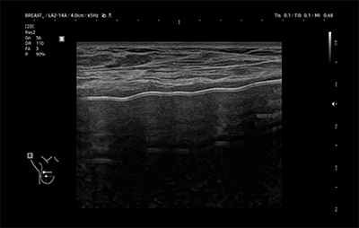 healthy breast USG implan img11