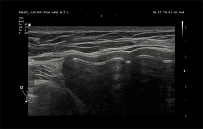 healthy breast USG implan img6