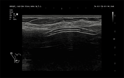 healthy breast USG implan img7