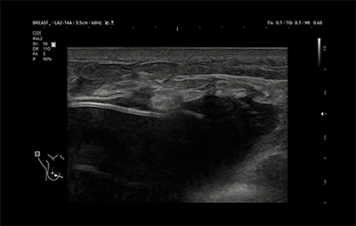 healthy breast USG implan img8