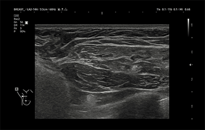 healthy breast USG implan img9
