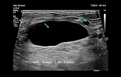 healthy breast USG kanker payudara img10