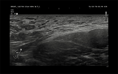 healthy breast USG kanker payudara img11