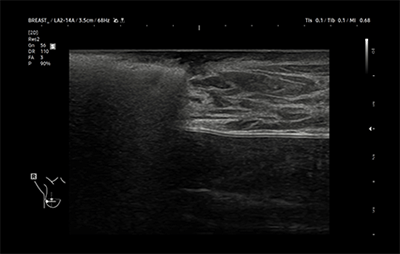 healthy breast USG kanker payudara img12