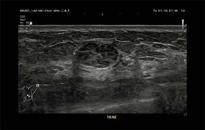 healthy breast USG kanker payudara img7