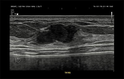 healthy breast USG kanker payudara img8