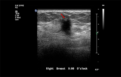 healthy breast USG kanker payudara img9